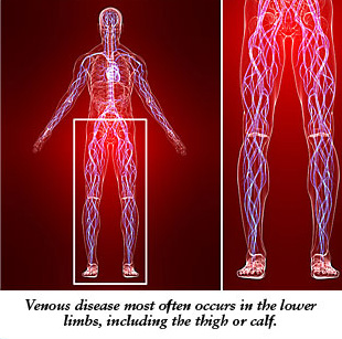 Venous Disease